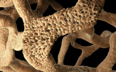 A csontritkulás megelőzése – Már fiatalkorban tennünk kell érte!